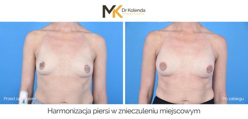 Harmonizacja piersi