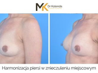 Powiększanie biustu przed i po - 874944