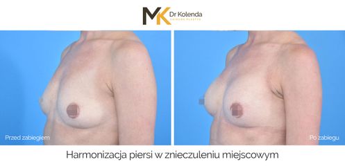 Harmonizacja piersi