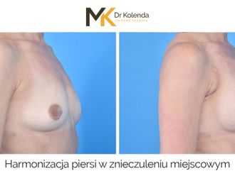 Powiększanie biustu przed i po - 874945