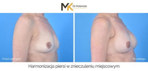 Harmonizacja piersi