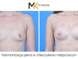 Powiększanie biustu przed i po - 874946