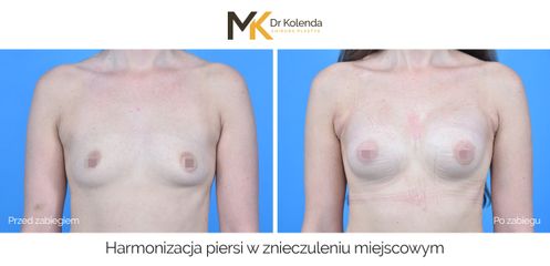 Harmonizacja piersi