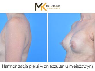 Powiększanie biustu przed i po - 874948