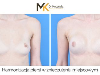 Powiększanie biustu przed i po - 874949