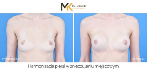 Harmonizacja piersi