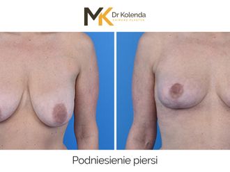 Mastopeksja przed i po - 875227