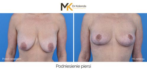 Podniesienie piersi