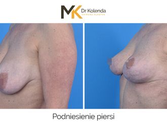 Mastopeksja przed i po - 875228
