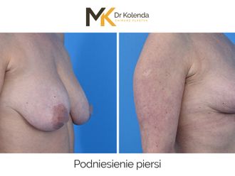 Mastopeksja przed i po - 875229