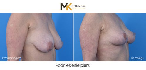 Podniesienie piersi
