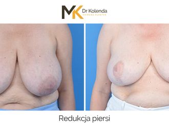 Zmniejszenie biustu przed i po - 875230