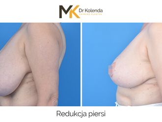 Zmniejszenie biustu przed i po - 875231