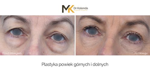Plastyka powiek