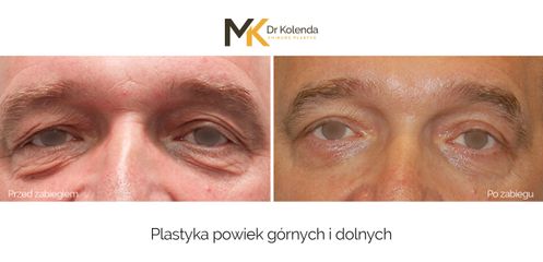 Plastyka powiek
