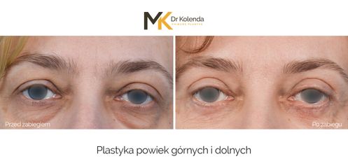 Plastyka powiek