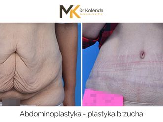 Plastyka brzucha przed i po - 875236