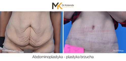 Plastyka brzucha