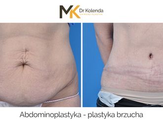 Plastyka brzucha przed i po - 875237