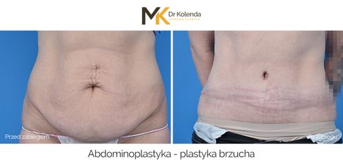Plastyka brzucha