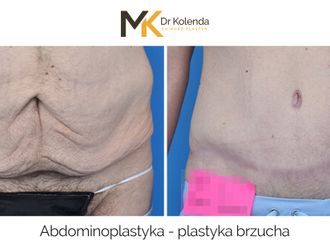 Plastyka brzucha przed i po - 875238