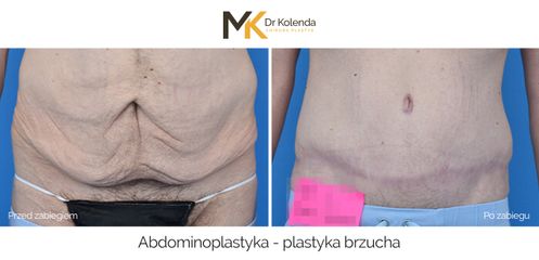 Plastyka brzucha