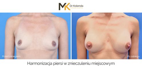 Harmonizacja piersi w znieczuleniu miejscowym