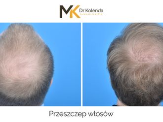 Przeszczep włosów przed i po - 876334