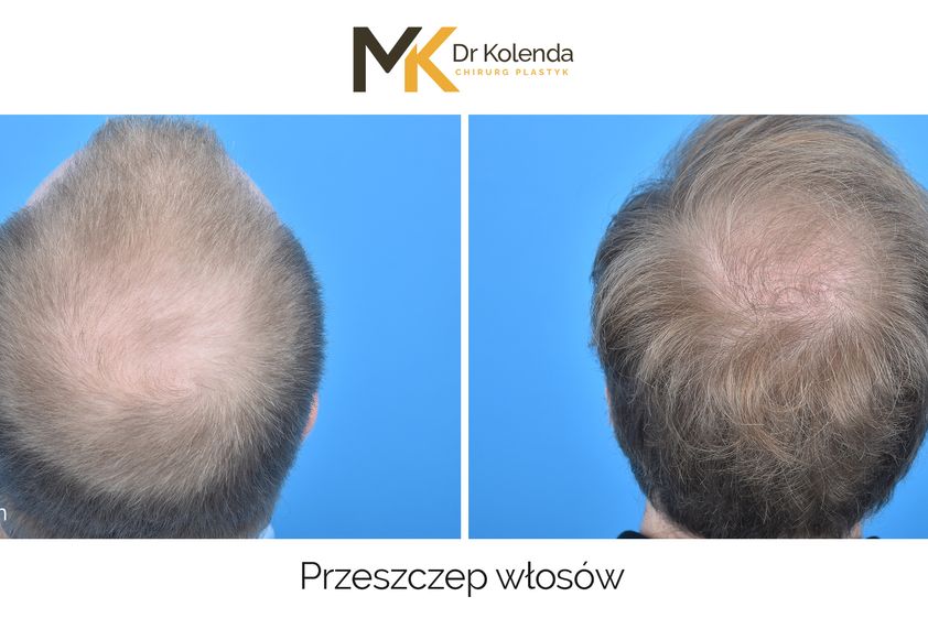 Przeszczep włosów przed i po - 876334