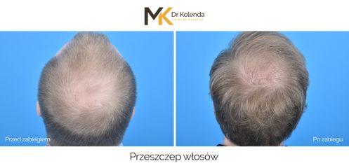 Przeszczep włosów