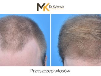 Przeszczep włosów przed i po - 876335