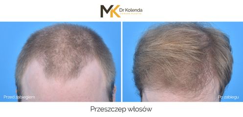 Przeszczep włosów