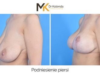 Mastopeksja przed i po - 876337