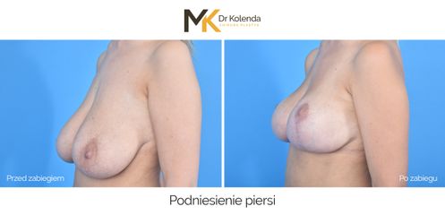 Podniesienie piersi