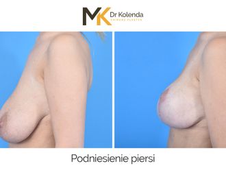 Mastopeksja przed i po - 876338