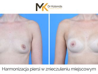 Powiększanie biustu przed i po - 876339