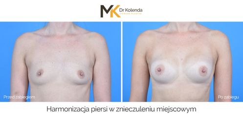 Harmonizacja piersi