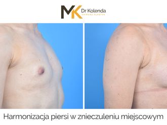 Powiększanie biustu przed i po - 876341
