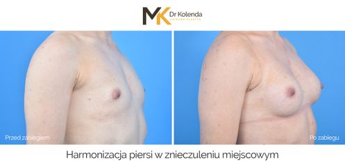 Harmonizacja piersi