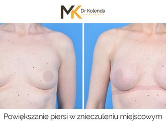 Powiększanie biustu przed i po - 877935