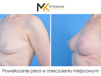 Powiększanie biustu przed i po - 877936