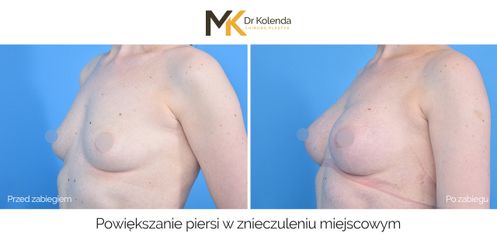 Dr. n. med. Małgorzata Kolenda Podpowięziowe biustu