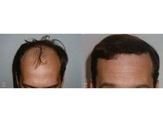 Przed i po: leczenie łysienia