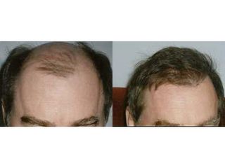 Przed i po: leczenie łysienia