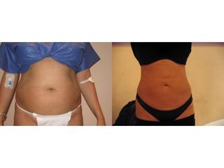 Body Jet - przed i po