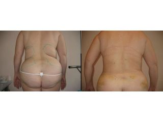 Body Jet - przed i po