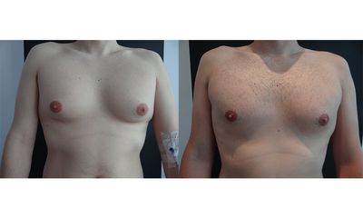 ginekomastia_1_set