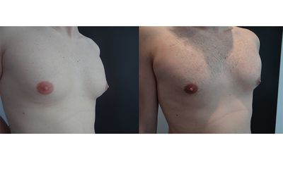 ginekomastia_2_set