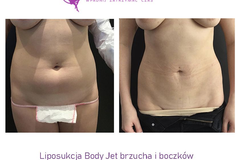 Liposukcja przed i po - 835955