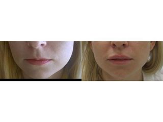 Przed i po - powiększanie ust kwasem hialuronowym